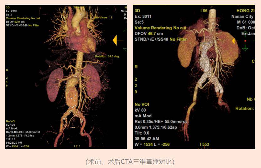 南安市醫院成功開展一例複雜腹主動脈瘤介入治療_手術_擴張_cm