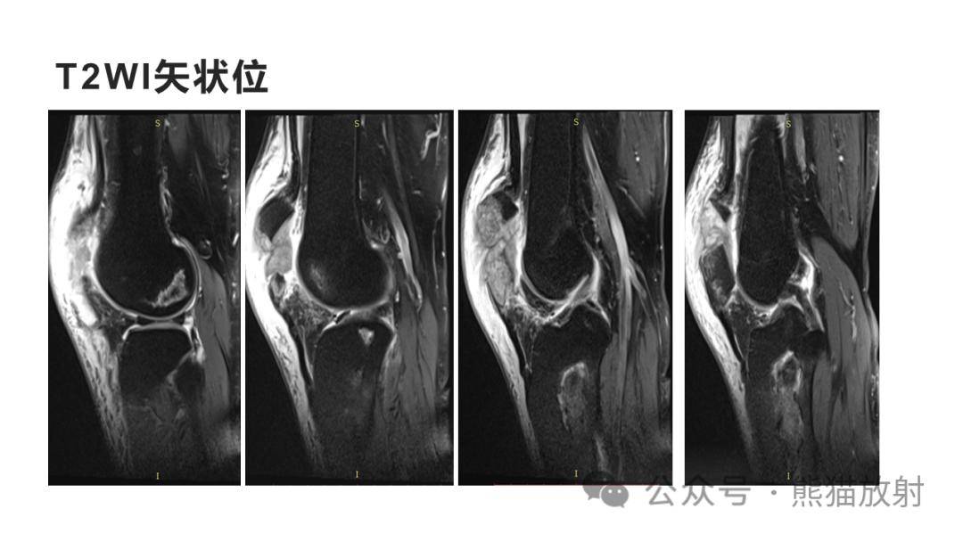 軟骨母細胞瘤,骨梗死,內生軟骨瘤你想到了嗎?有收穫嗎?