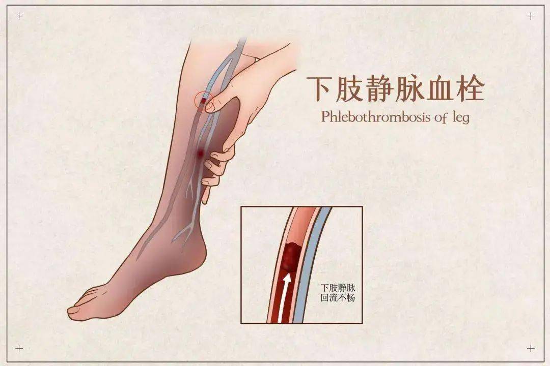 动起来 栓不住 预防深静脉血栓有办法