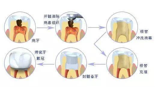 根管治療不戴冠,遲早留後患_牙齒_牙冠_活動