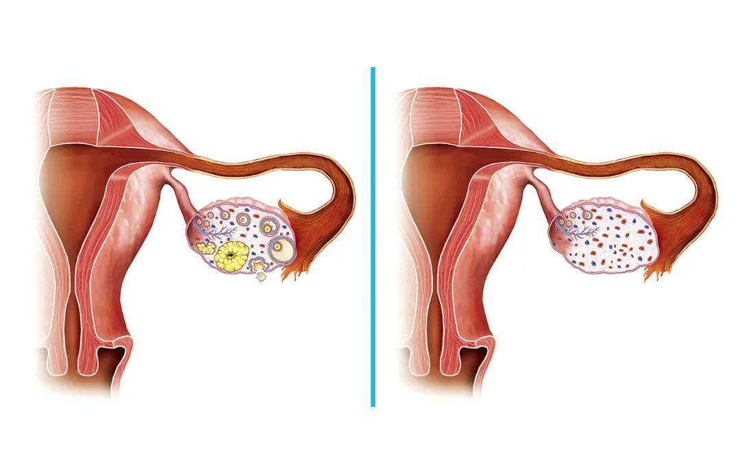 女生未满19岁确诊卵巢早衰