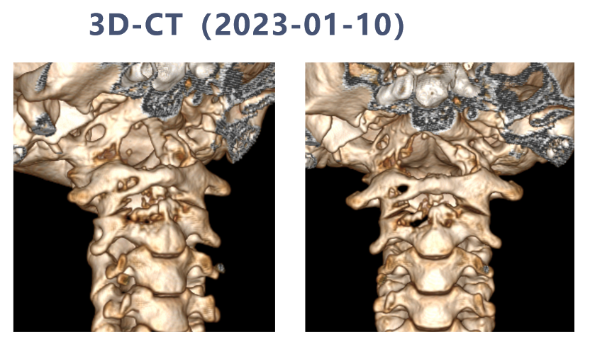 宣武有术|后路联合极外侧入路颅颈交界脊索瘤切除 颈椎四棒系统固定