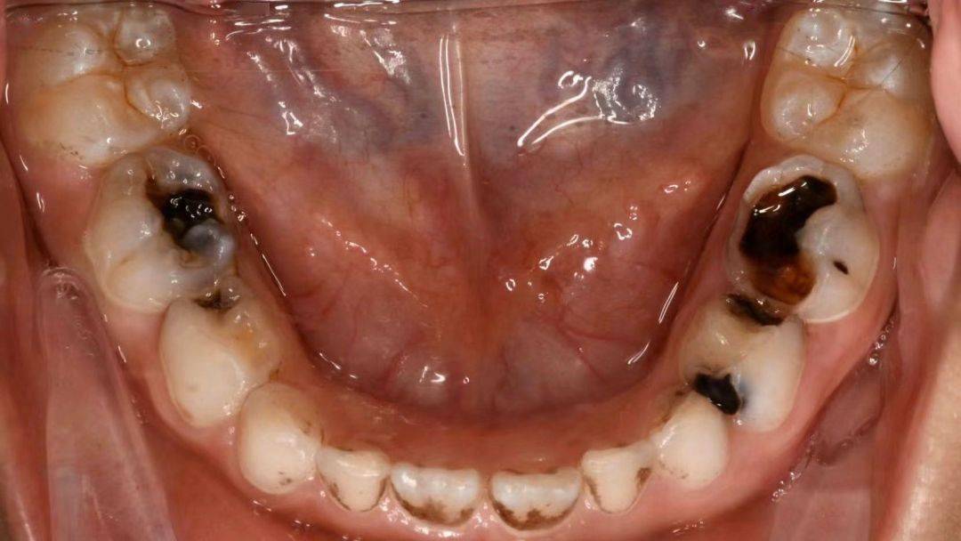 龋齿:是牙菌斑已经侵蚀到牙齿内部,保护层遭受到破坏,牙体受损