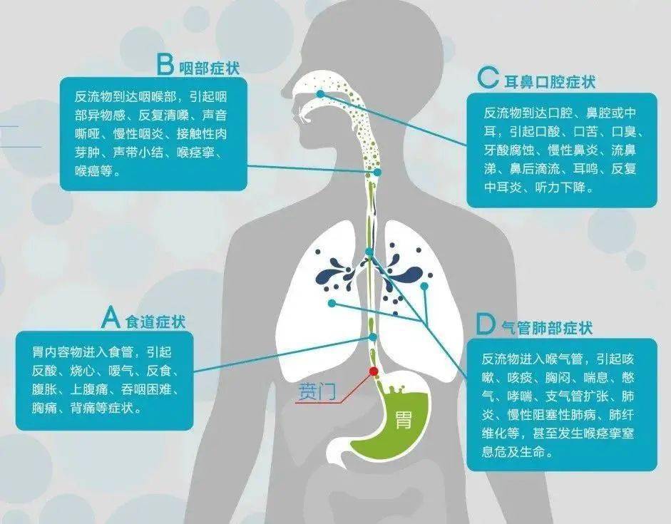 一文了解——反流性食管炎