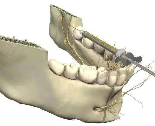利多卡因下牙槽阻滞麻醉诱发癔病发作_患者_治疗_给予