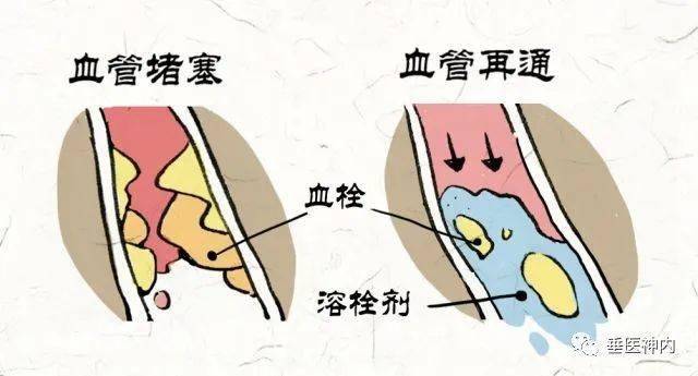 急性脑梗死患者静脉溶栓的护理_进行_治疗_小时