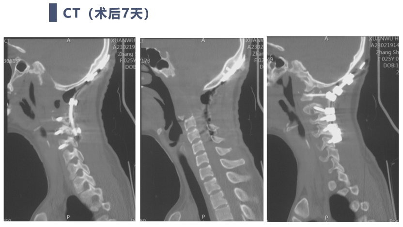 宣武有術|後路聯合極外側入路顱頸交界脊索瘤切除 頸椎四棒系統固定