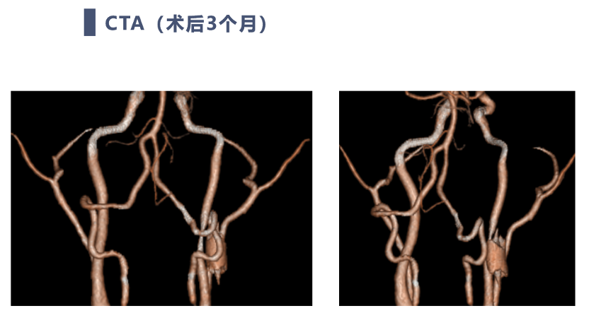 c1-2骨質切除範圍軸位ct顯示c1-2骨質切除範圍,雙側c3椎弓根螺釘位置