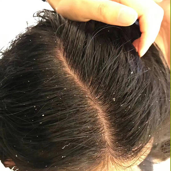 国产洗发水品牌排行榜前十名_头皮_头发_去屑