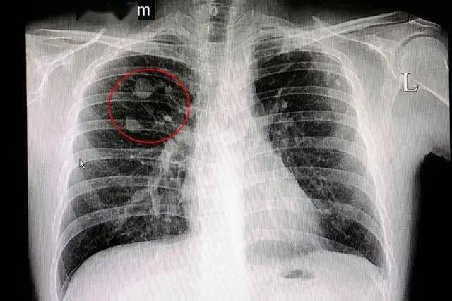 肺部肿瘤图片 x光片图片