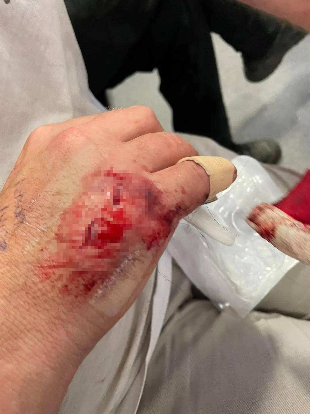 新西兰华人爆料：老公出门遭恶犬无故撕咬，鲜血淋漓！至今找不到狗和主人......