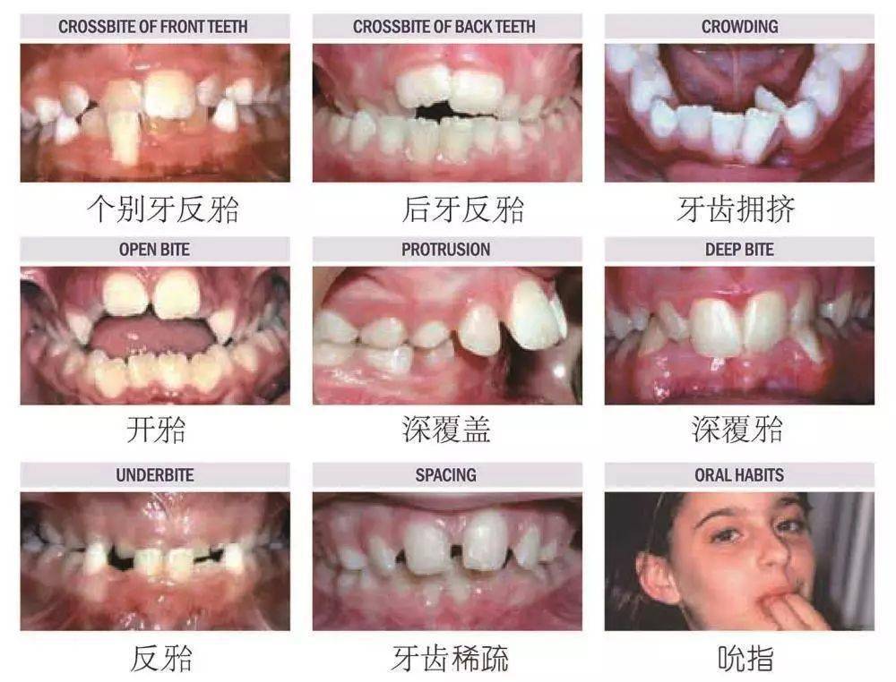 恆牙_牙齒_兒童