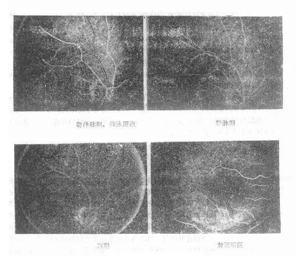 眼底熒光血管造影法操作及分析_主動脈_視網膜_視盤