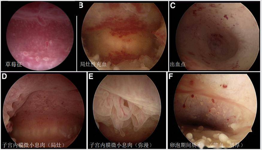 宫颈上有草莓斑点图片图片