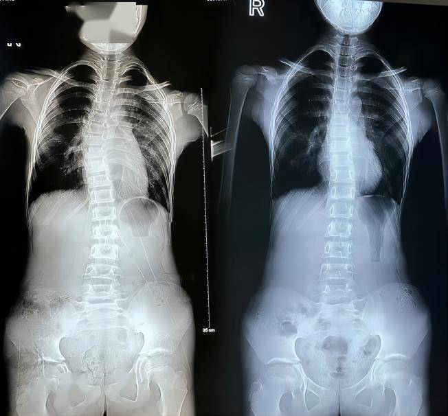 脊椎侧弯训练营开营在即