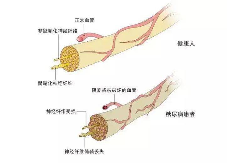 糖尿病神经病变图片