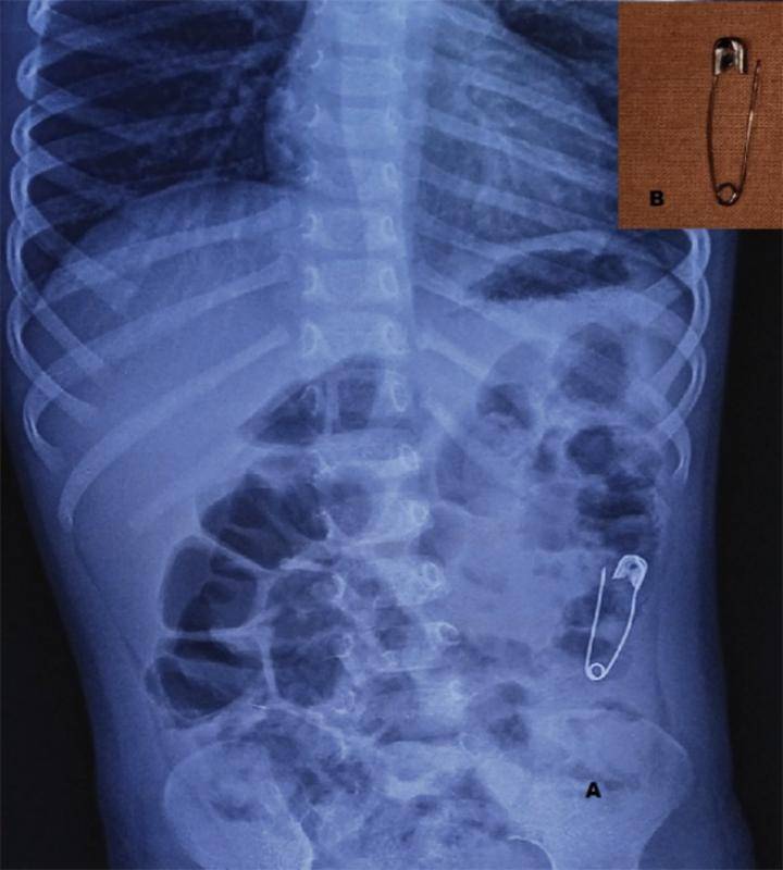 體內發現6mm長的鋼釘這是一位患兒攝入釘子的腹部平片,無明顯異常症狀