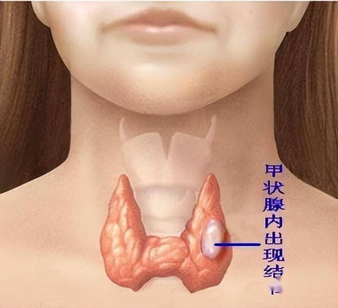 此外,有甲狀腺癌家族史的患者及既往有甲狀腺癌病史的患者,是甲狀儋