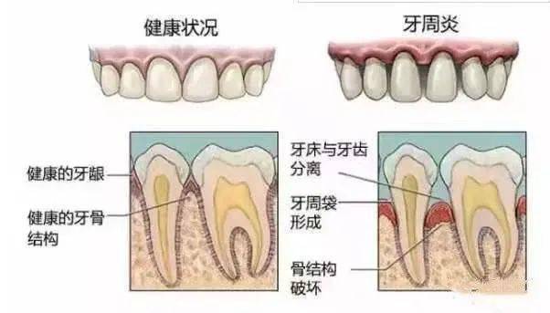 解決方法送給你!_牙齒_牙齦_牙縫