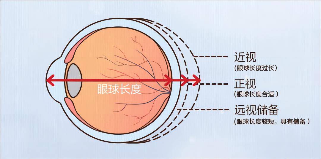 近视眼结构图图片