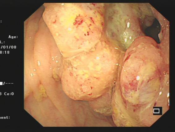头晕乏力,居然是因为大肠里有两个肿瘤!_升结肠_老奶奶_直肠