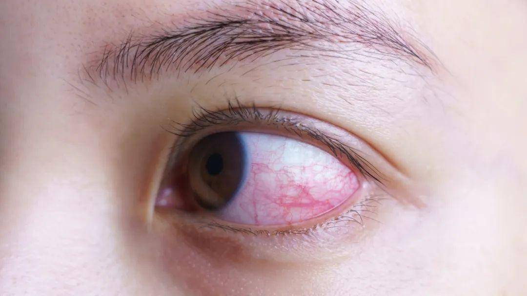 急性结膜炎最常见的症状就是眼白部分异常发红,尤其眼皮里面(睑结膜