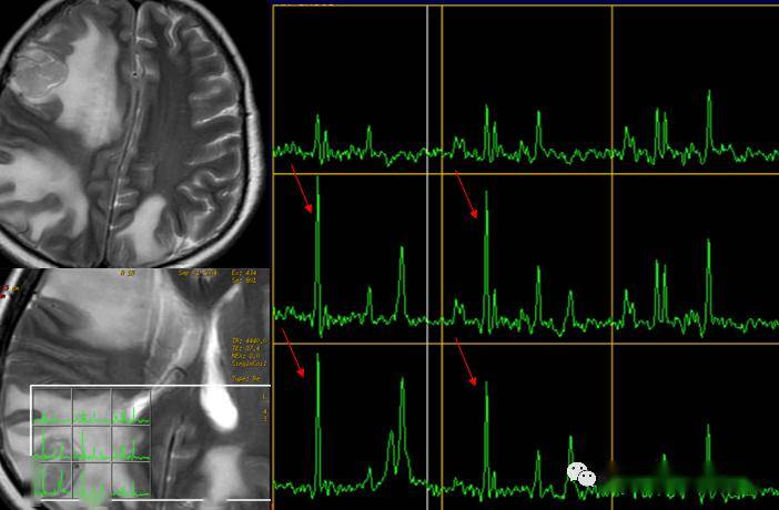 一文读懂磁共振波谱(mrs)成像_ppm_代谢_choline