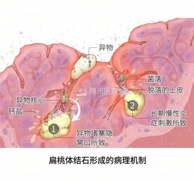 隐窝内落入的食物残渣,细菌,代谢产物形成的团块和脓性分泌物(含免疫