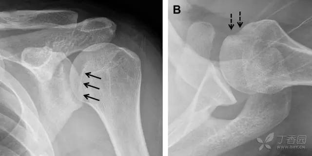 此「凹槽徵」與肱骨頭關節面平行;(b)腋位片進一步證實了骨折的存在29