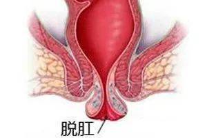 肛门脱垂的症状图片