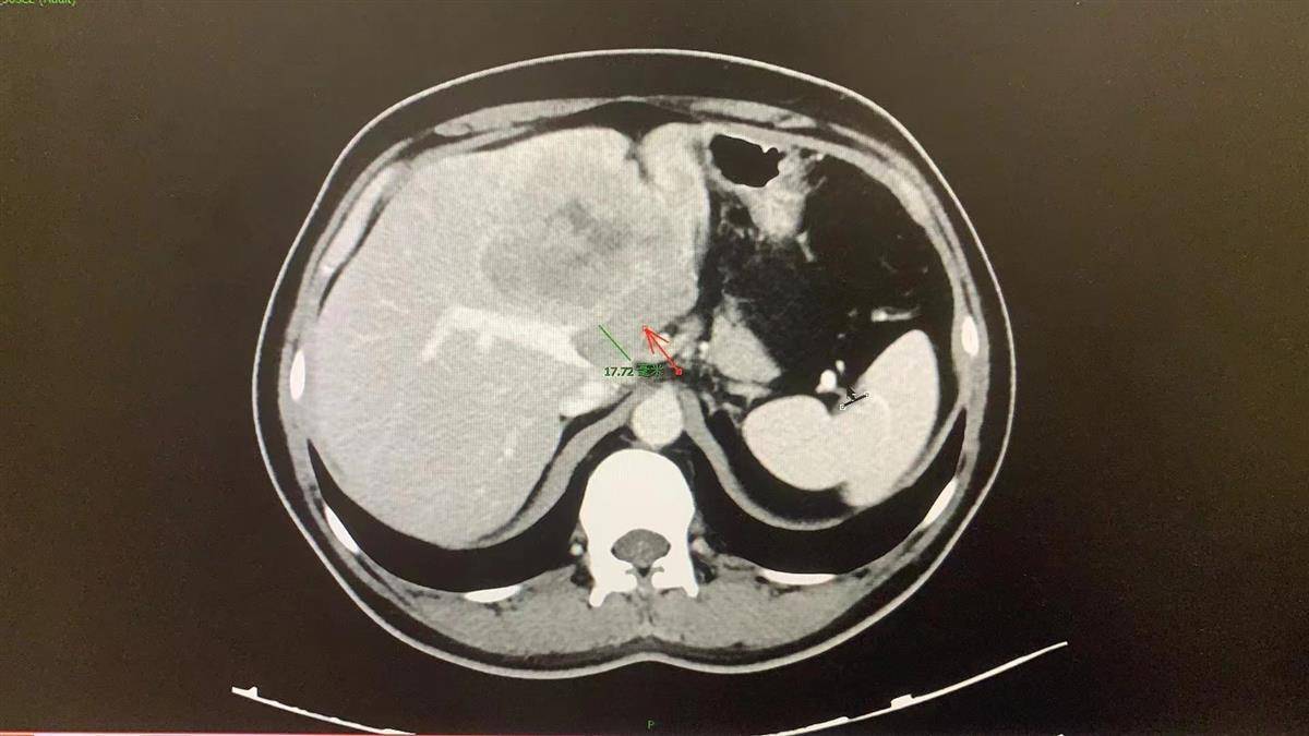 肝癌ct片图片图片