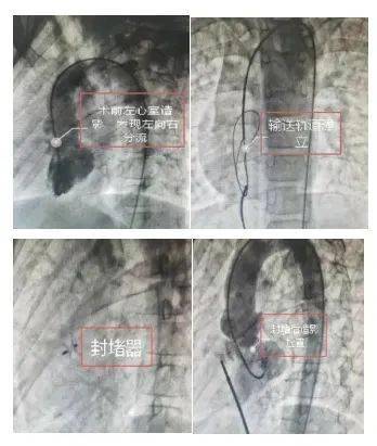 【佑安服务】首例,北京佑安医院心内科成功实施室间隔缺损封堵术_患者