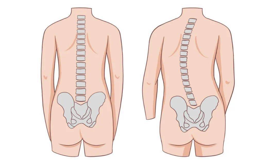 儿童脊柱正常形状图片图片
