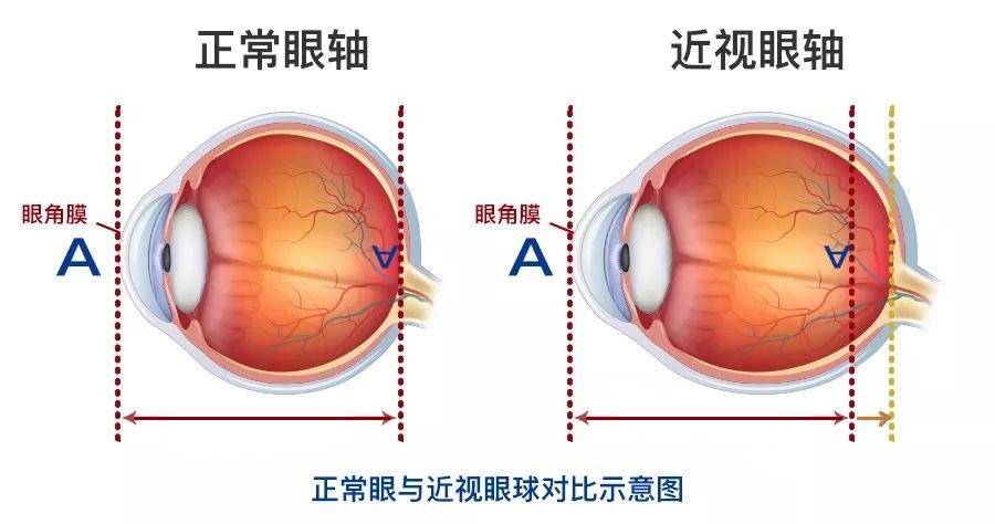 验光单≠配镜处方!如何正确下配镜处方