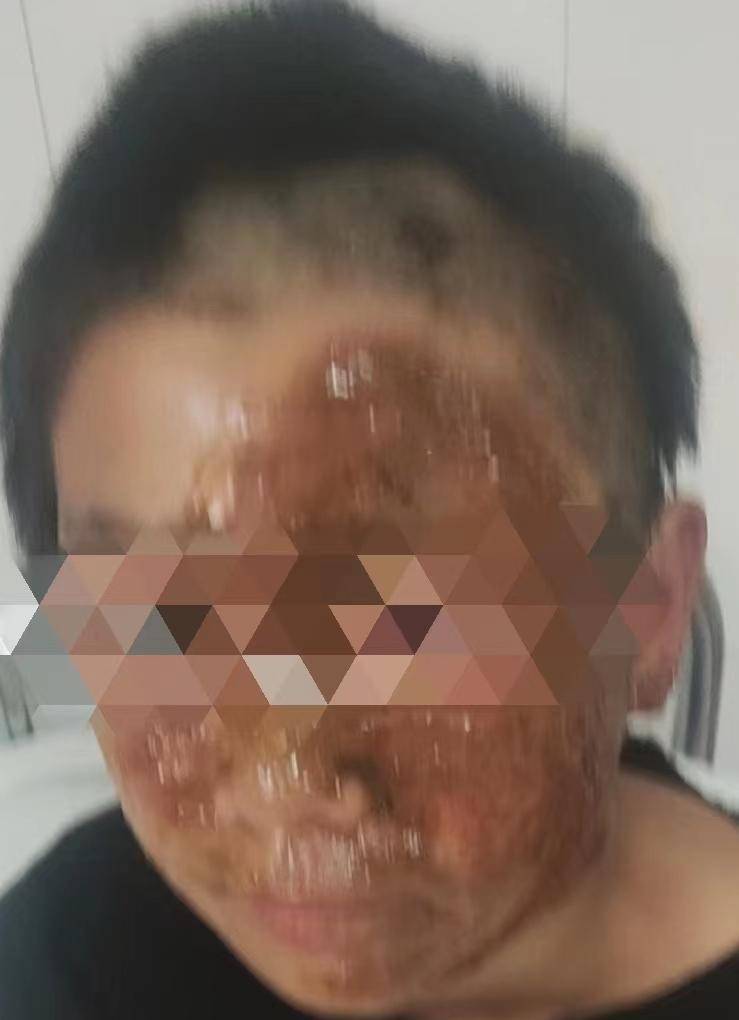 医生提醒:燃放烟花炮竹时谨防炸伤!_小浩_孩子_治疗