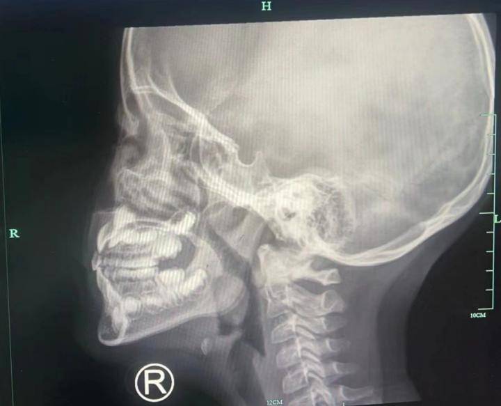 要知道,人体正常腺样体的大小不超过70%,扁桃体不超过2度.