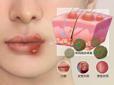 医生:可能是单纯疱疹病毒在
