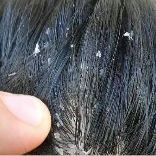 中国最安全的洗发水品牌_头皮