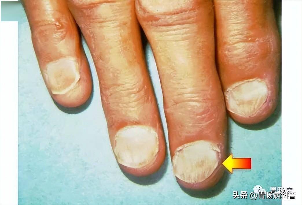 可能存在匙状甲(箭头)临床上有缺铁性贫血,吞咽困难,舌炎的临床表现