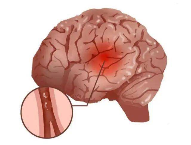 脑梗通常是由脑血管阻塞引起的,导致血液无法流向大脑的某个区域,从而