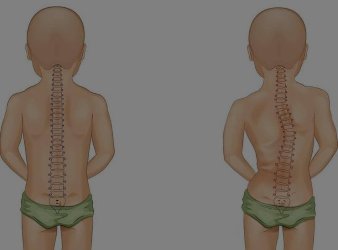 脊柱侧弯是一种常见的脊柱畸形,通常表现为脊柱在正常位置上出现侧弯.