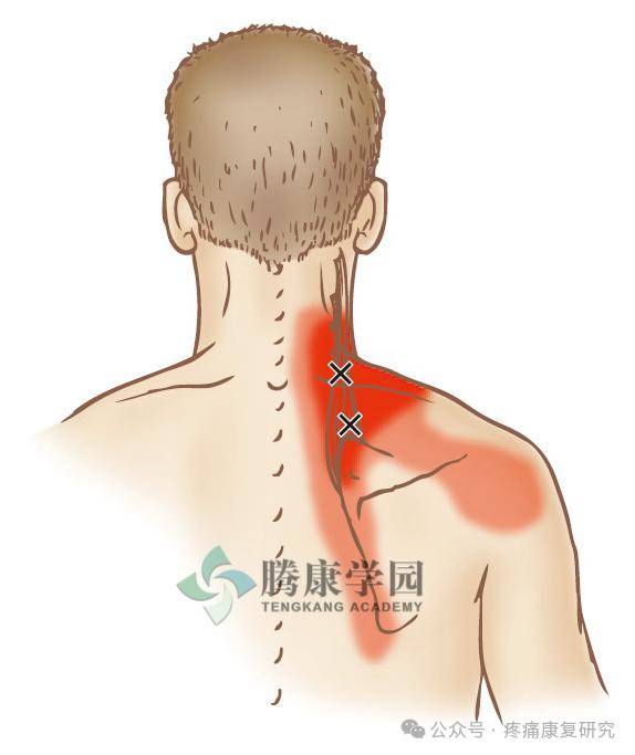 除了上斜方肌外,潜伏性触发点在肩胛提肌里比在其它任何的肌肉里要来