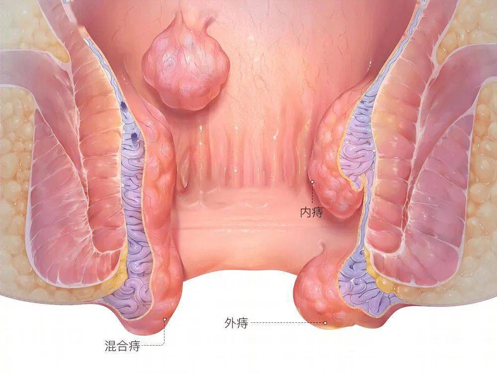 女生痔疮长啥样子的图片