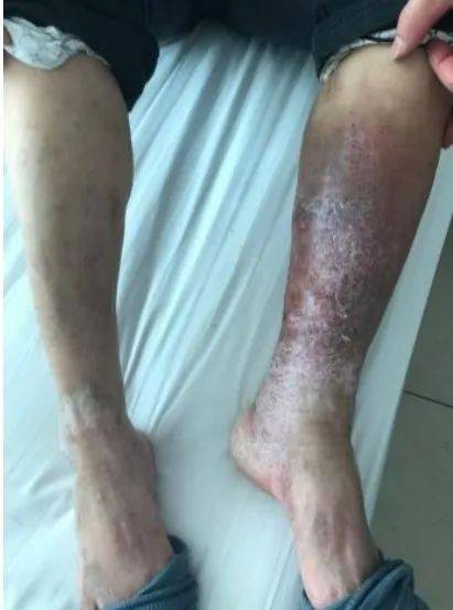 【新闻快递】普外二科:介入手术 驯服"脱缰"的深静脉血栓_血管_下肢