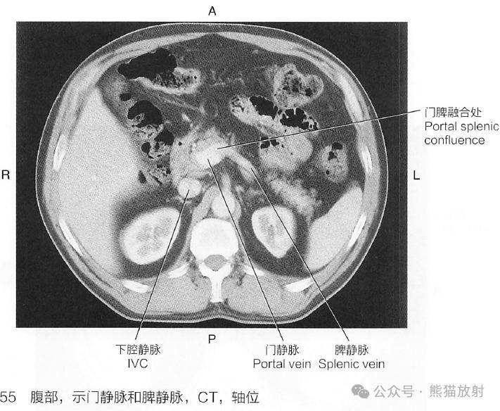 门脉系统解剖图片