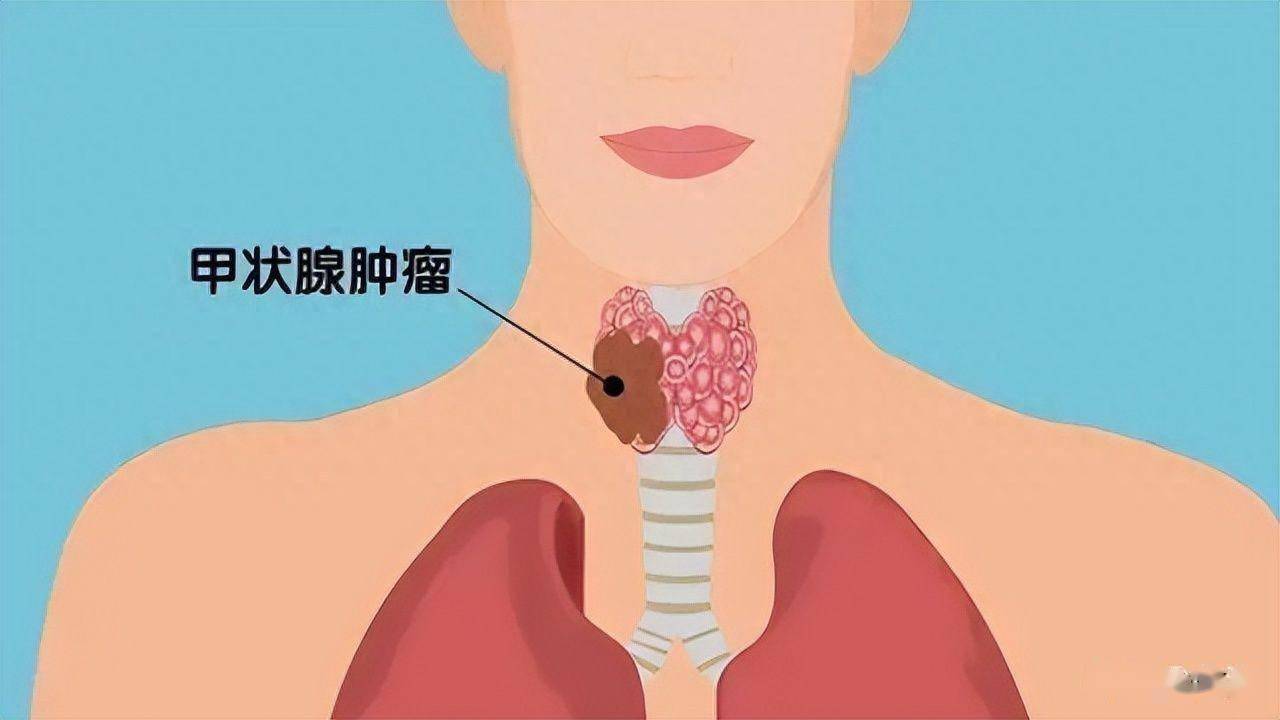 甲状腺癌难发现?应关注4个症状和3个诱因