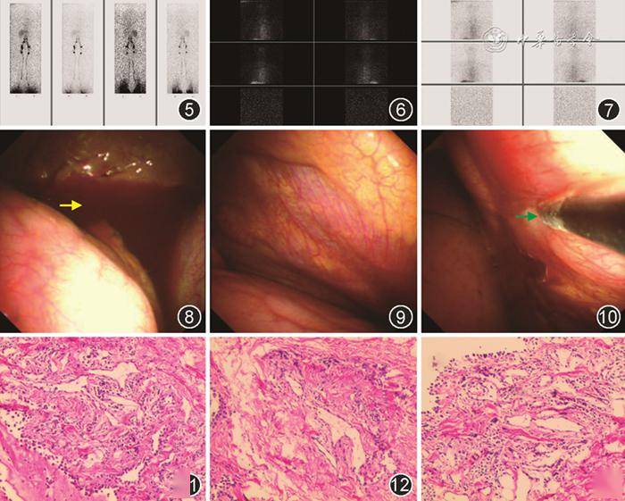 【读片园地】胸骨柄及双侧锁骨头骨质破坏并双侧血性胸腔积液_患者