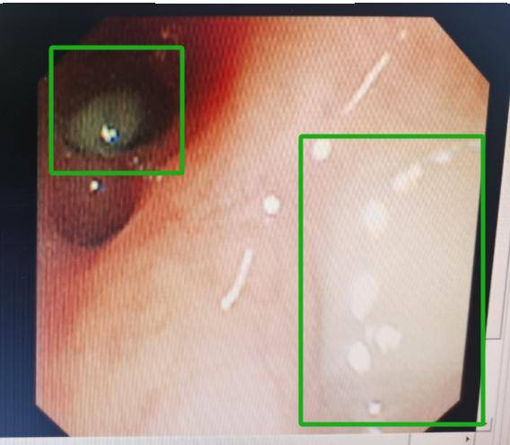 左上肺塑型及粘液栓堵塞左肺舌叶二次处理后很多时候,孩子的笑容既能