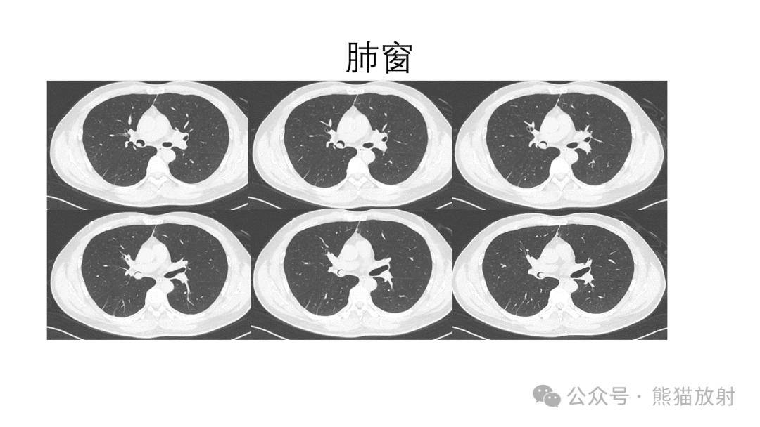 【省立影像读片】气管支气管肿瘤24.02_内容_检索_公众