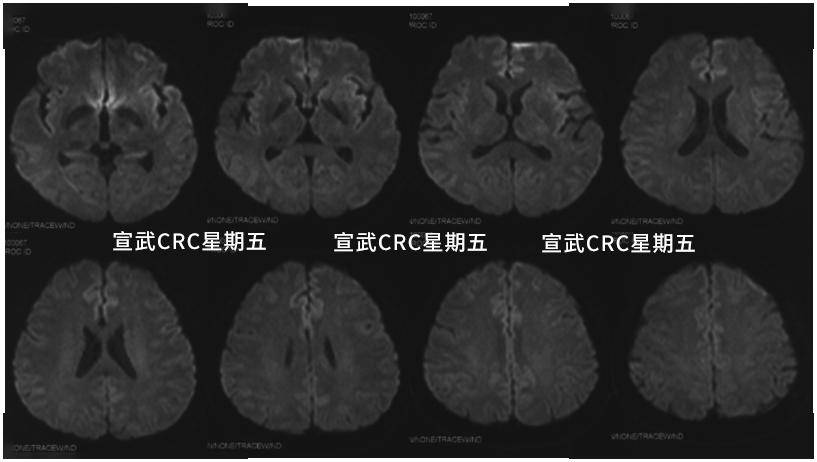 继续给予替罗非班 氯吡格雷方案抗栓治疗,加用甲强龙减轻缺血后脊髓